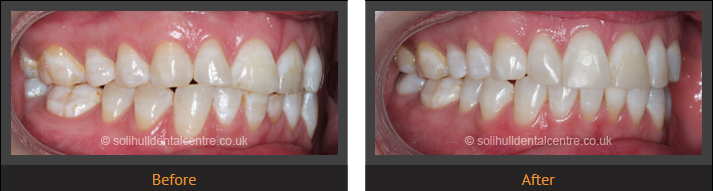 orthodontics before and after side view, right