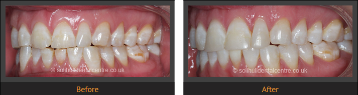 orthodontics before and after side view, left