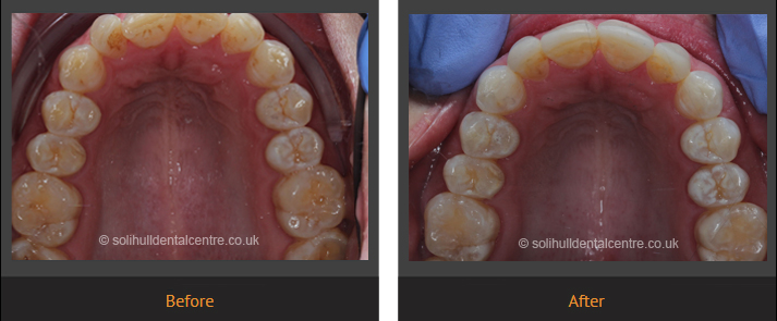 orthodontics before and after occlusal view upper