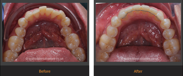 orthodontics before and after lower occlusal view