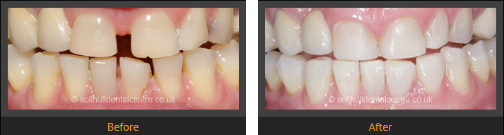 dental implant photographs
