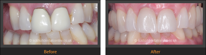 dental implant cases
